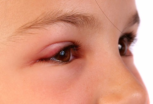 Cum protejăm copiii de alergiile oculare