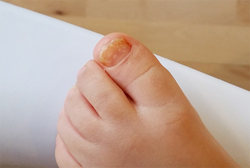 ciuperca unghiilor pe pielea picioarelor cum să trateze