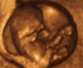 dezvoltarea-bebelusului-in-sarcina-10-saptamani-ecografie-3D