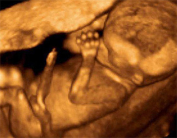 dezvoltarea-bebelusului-in-sarcina-14-saptamani-ecografie-3D