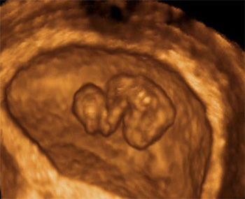 dezvoltarea-bebelusului-in-sarcina-7-saptamani-ecografie-3D