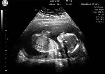 dezvoltarea-bebelusului-in-sarcina-7-saptamani