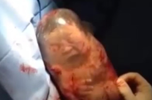 Nasterea bebelusului cu sacul amniotic intact