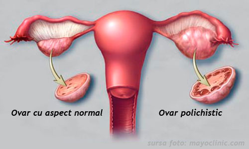 Sindromul ovarului polichistic - Simptome, diagnostic si tratament