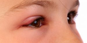 cum-protejam-copiii-de-alergiile-oculare.jpg