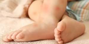 iritatii mancarimi inrosiri caldura bebeusi