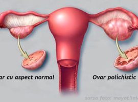 sindromul-ovarului-polichistic-simptome-diagnostic-si-tratament.jpg