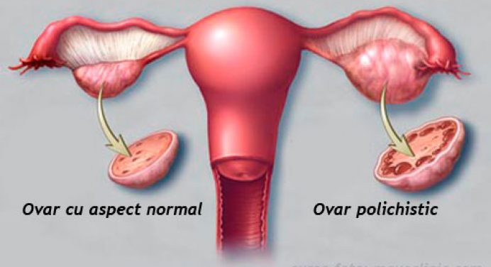 sindromul ovarului polichistic greu de pierdut în greutate