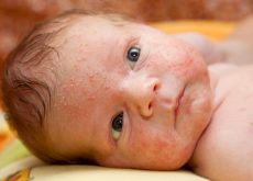 Rujeola la copii Cum se diferentiaza de rubeola si varicela