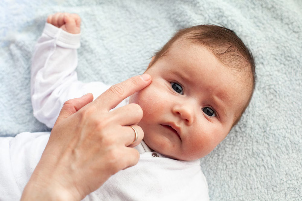 dermatita-atopica-bebe-iarna