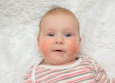 dermatita atopica bebelusi iarna