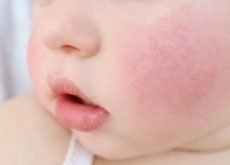 alergii cutanate la bebelusi