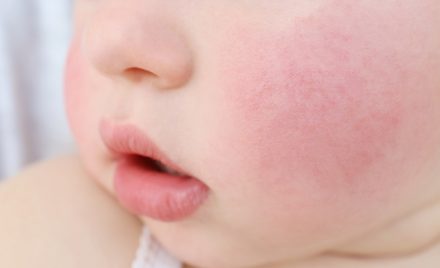 Dermatita atopica bebelusi alimente interzise