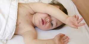 sindrom post covid la copii