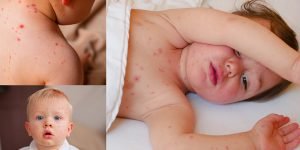 bolile-contagioase-la-copii-rujeola-rubeola-oreion-roseola-infantul-boala-6