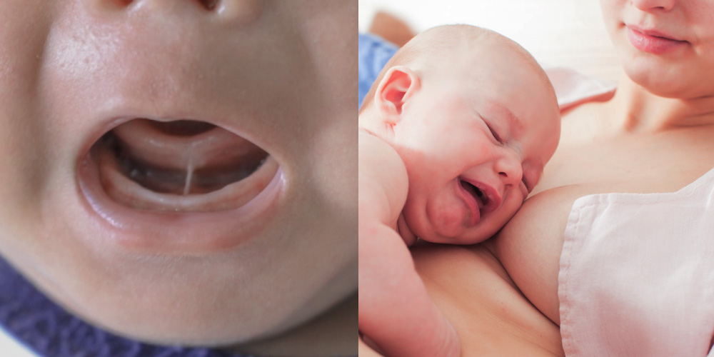 Attempt Cafe Noisy Frenul restrictiv poate afecta hrănirea la sân a bebelușului. Intervenția  de frenectomie (tăierea frenului lingual) - Clubul Bebelusilor